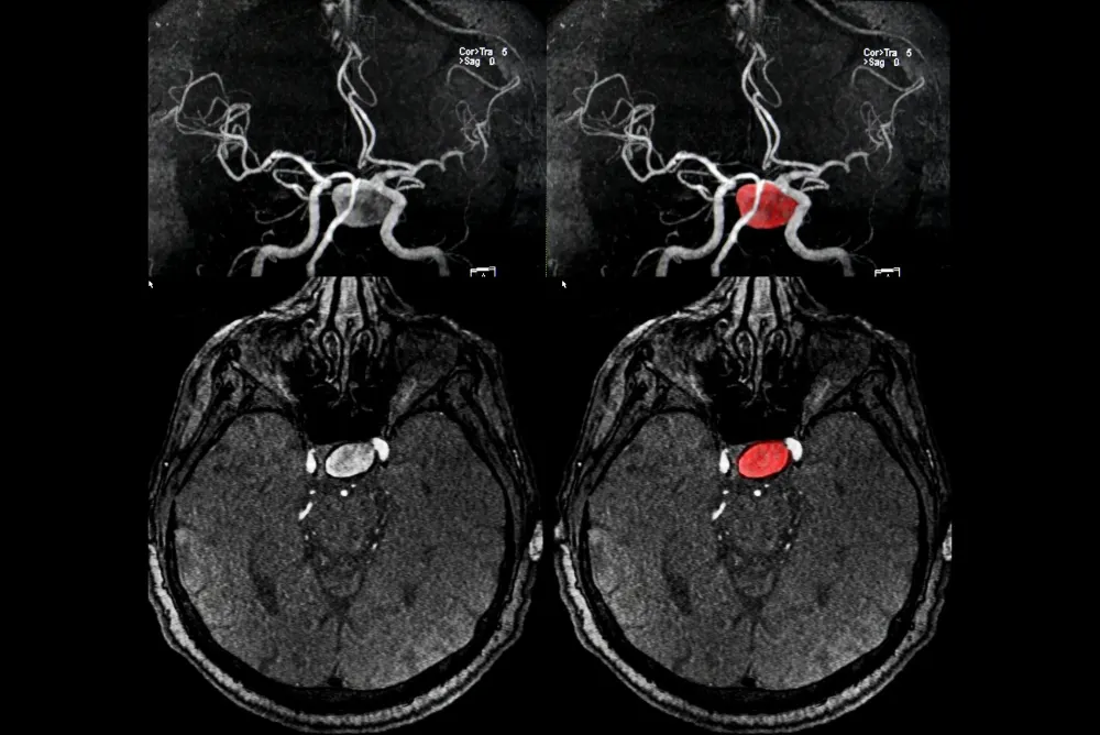 Recovery and Follow-up After Aneurysm Coiling